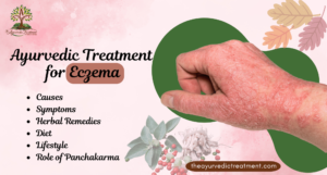 Ayurvedic Treatment for Eczema: Causes, Symptoms, Herbal Remedies, Diet, & Role of Panchakarma